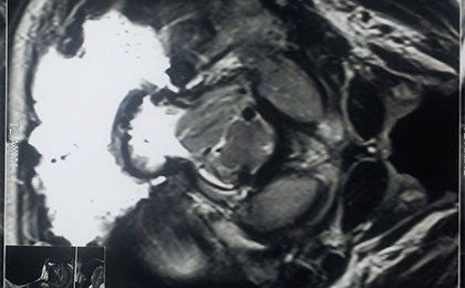 post op ar ch 2 axial