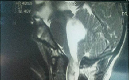 Arnold Chiari Malformation