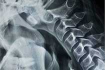 Atlantoaxial Dislocation Flexion