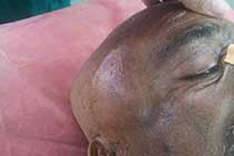 Scalp Abscess