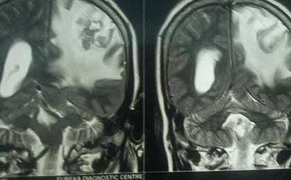 brain met pre op