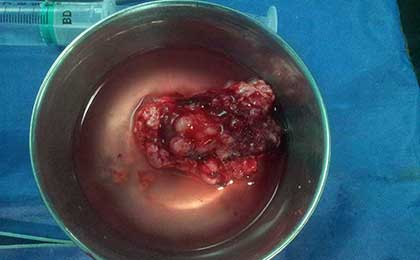 Arnold Chiari Malformation
