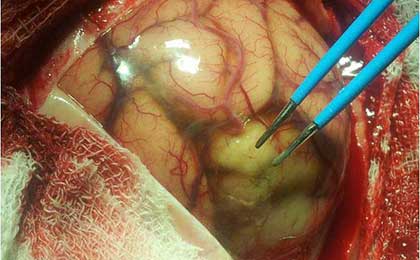 Arnold Chiari Malformation
