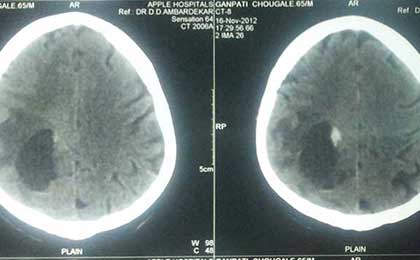 brain metastases