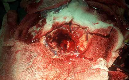 Post OP Cavity After Excision