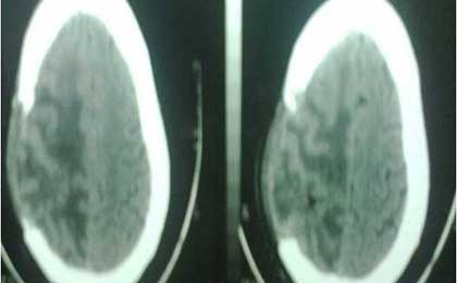 Post OP CT