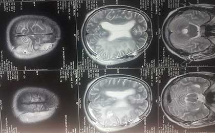 Post OP MRI Of CA Ovary With Brain Met