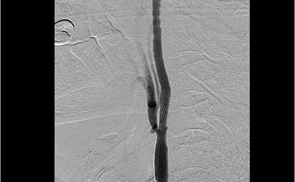 post stenting DSA