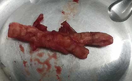 carotid-endarterectomy