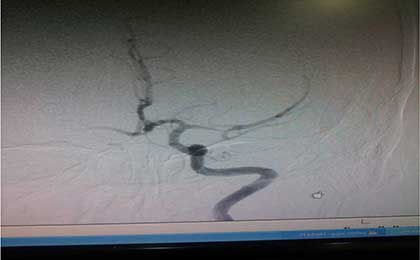 dsa of mca stenosis