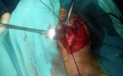 intra op carotid end
