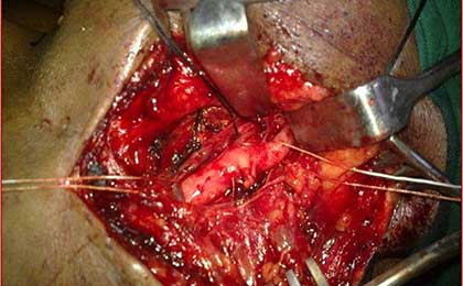 intra op carotid exposure