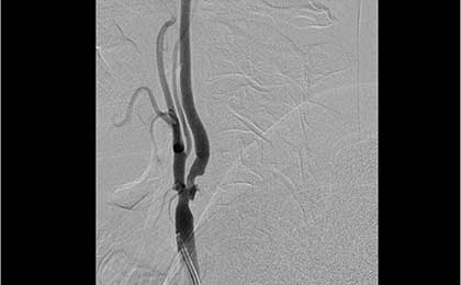 pre stenting dsa