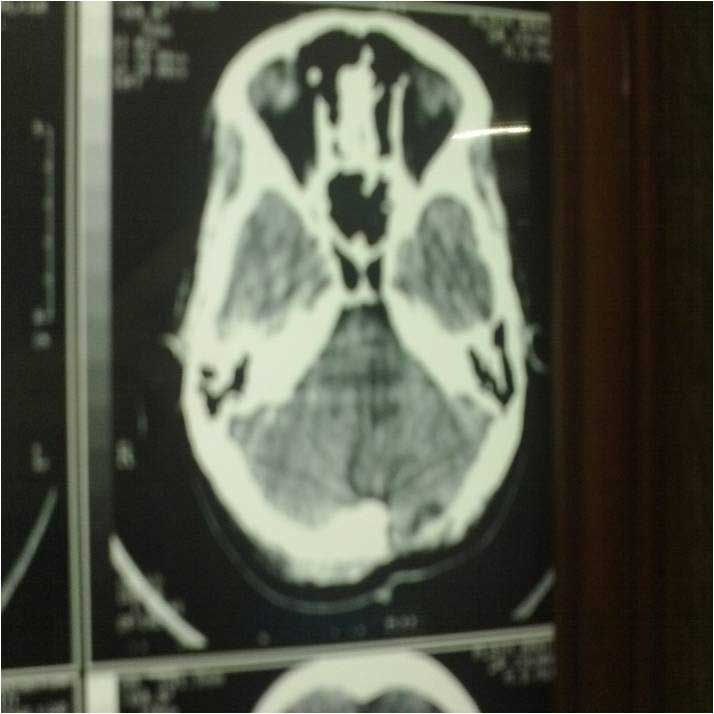 post op ct scan