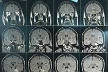 cp angle meningioma