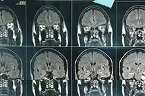cp angle meningioma pre op