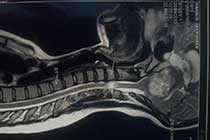 nf02 preop