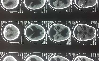 post op ct