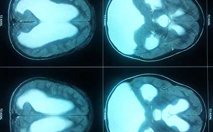 preop mri