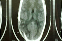 Post CT