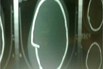 pre op bone window