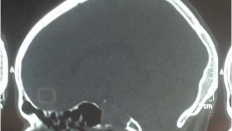 Endoscopic Surgery