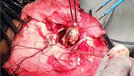 Epilepsy Surgery