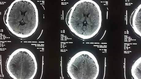 Epilepsy Surgery