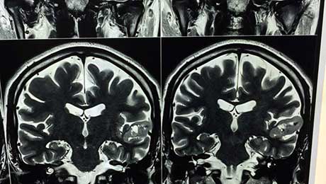 Epilepsy Surgery