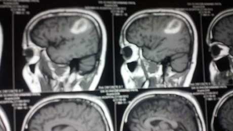 Epilepsy Surgery