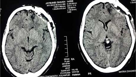 Epilepsy Surgery