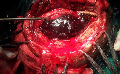 Extradural Haematoma