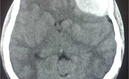 Extradural Haematoma