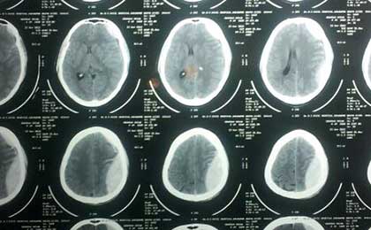 Extradural Haematoma