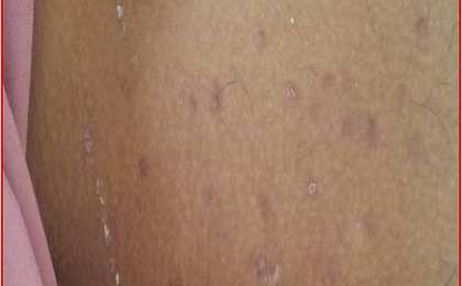 Fat Embolism Syndrome