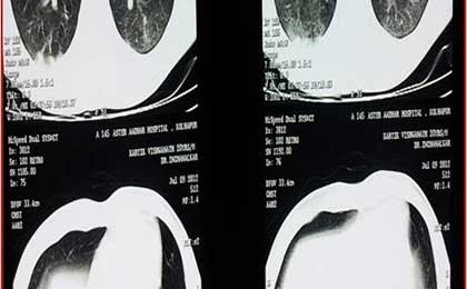 Fat Embolism Syndrome