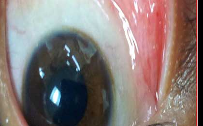 Fat Embolism Syndrome