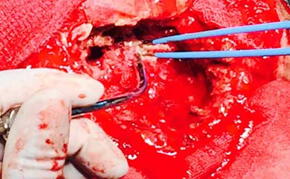 Gliomas of Brain