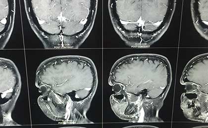 Gliomas of Brain