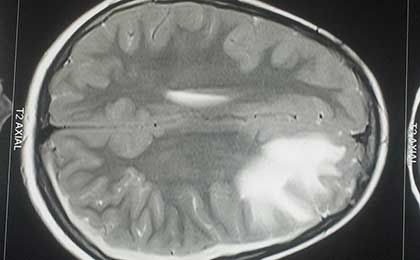 Gliomas of Brain