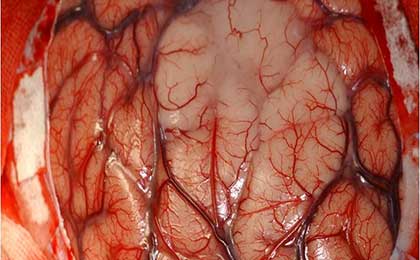 Gliomas of Brain