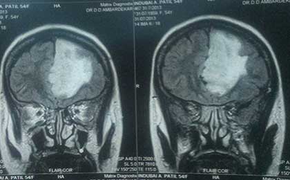 Gliomas of Brain