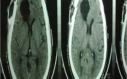 Gliomas of Brain