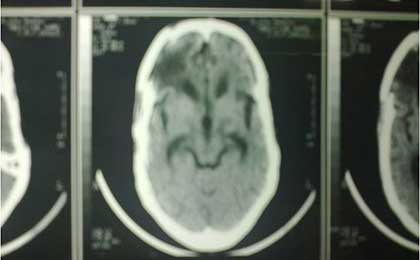 Gliomas of Brain