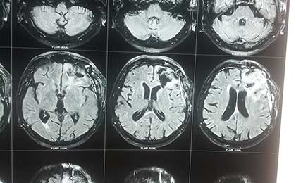Gliomas of Brain