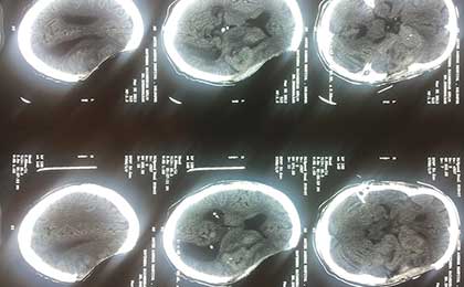 Gliomas of Brain