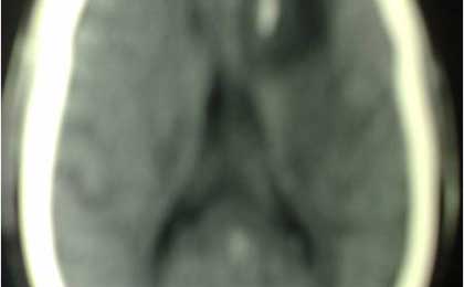 Gliomas of Brain