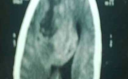 Gliomas of Brain