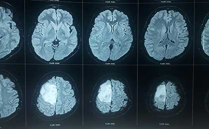 Gliomas of Brain