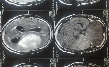 Gliomas of Brain